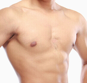 Gyneacomastia correction surgery model 01, Dr Jeremy Richardson